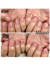 モアナ 池袋(MOANA)/人工爪深爪