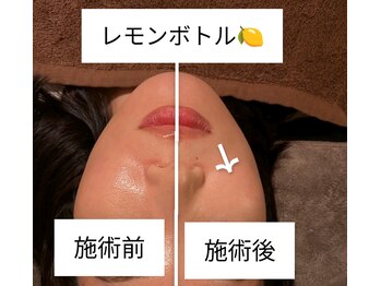 Salon Nicolly/レモンボトルのビフォーアフター