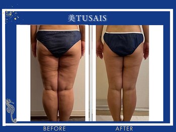 ビテュセスリー はなみずき店(美tusais3)/【痩身・ダイエット】ボディケア