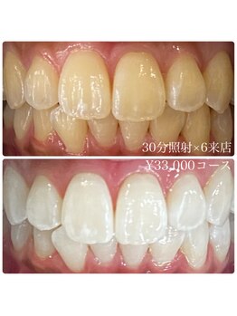 ホワイトニングルーム 横浜店(Whitening Room)/セルフホワイトニング/横浜