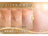 人気No1【シミ くすみ改善 2施術】光フェイシャル＆幹細胞導入18000→15000円