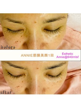 アニー(Annie)/Annie筋膜美顔