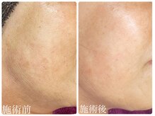 フォーチューン/ハーブ＋カスマラパックGOLD