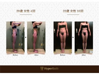 ハンズ鍼灸接骨院小牧院 美容整体ハンズ(美容整体hands)/お腹周りすっきり before after