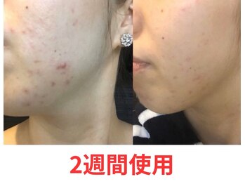 レビーリズ バイ サロンリーナ(Revie Liz)/VinatuleVC30効果