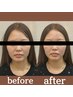 【モニター募集×驚愕の小顔に】ルート鬼美容鍼　《鍼100本程度》