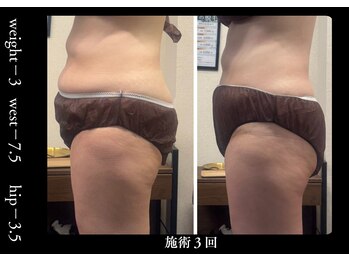 モミン(MOMI.N)/施術1回の成果