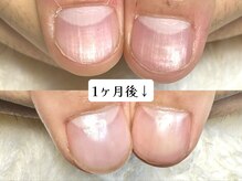 グラシナ なんば店/深爪/自爪育成/フィルイン