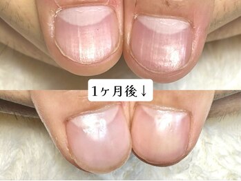 グラシナ なんば店/深爪/自爪育成/フィルイン