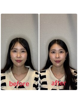 小林整骨院 本町/肌質改善美容鍼