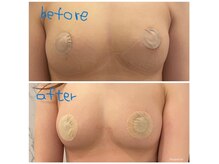 ルミエール(Lumiere)の雰囲気（バストアップ施術後のビフォーアフター）