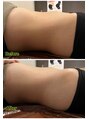 ラルーチェ(LaLuce)&nbsp;腸リンパの1回の施術結果です。あお腹周りが気になる方は是非！