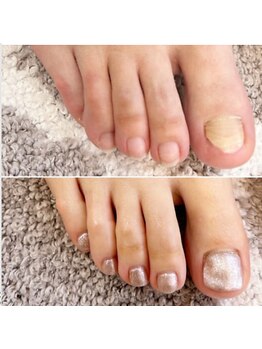 ココモ(cocomo)の写真/足の深爪やむしりぐせ、もう悩まない！即日見た目を変える◎10本長さだしで輝く指先を演出♪
