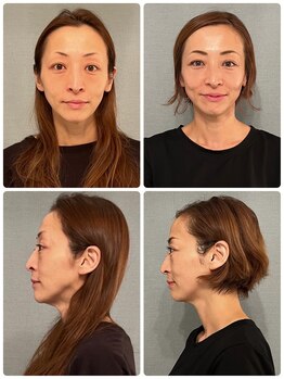 カナエルサロン 旭川(KANAERU SALON)/【小顔ケア】症例☆