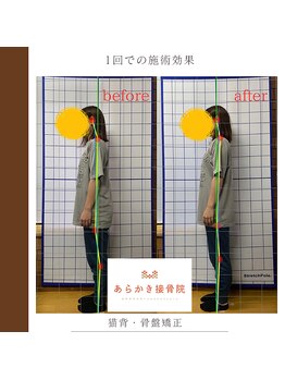 あらかき接骨院/【姿勢の変化】