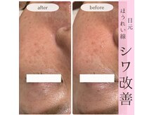 マイクロニードルピーリングでニキビケア＆シミシワケア☆