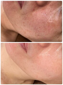 リノア(LINORE)/ハーブピーリング(剥離なし)半年