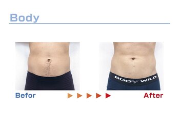 キングスサロン 熊本/お腹脱毛