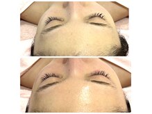 サロン ド リン(Salon de Lynn)の雰囲気（コラーゲンピールと同等WiQo水光ピーリングでハリ・ツヤ実感！）
