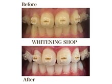ホワイトニングショップ 尾道店(WHITENING SHOP)の雰囲気（ホワイトニングは矯正中の方でもOK！！）