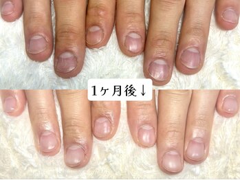 グラシナ なんば店/深爪/自爪育成/フィルイン