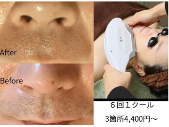 デコアイ(Deco eye)の写真/脱毛しながらお肌も綺麗に！脱毛で毛穴をケアし、自信あふれる素肌を目指す★