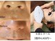 デコアイ(Deco eye)の写真/脱毛しながらお肌も綺麗に！脱毛で毛穴をケアし、自信あふれる素肌を目指す★