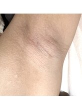 ミーエイト(Mii∞)/《両脇の脱毛効果》