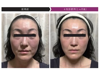 パーフェクトフェイスビューティー 梅田店(PERFECT FACE BEAUTY)/ディレイアコスメ（1種）使用