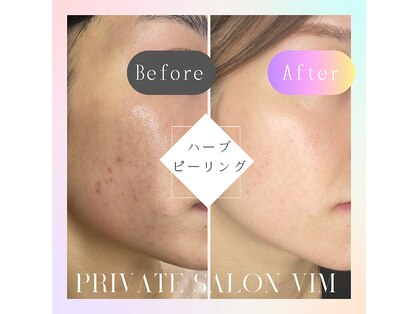 ヴィム(VIM)の写真