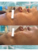 ポノ(Pono)/ハーブピーリング1回での効果☆