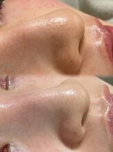 タルボ(TALBO)/汚れた毛穴をスッキリ美人