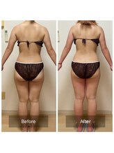 ヨサパーク ベア(YOSA PARK Beat)/30代女性 before after