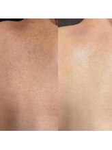 マヤヒメ(mayahime)/お背中ハーブピーリング