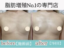 サラエクセレント 銀座/バストアップしてバージスライン