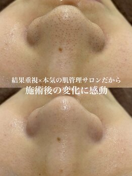 ホワイトラボ 堺東(White labo)の写真/【本格肌管理】韓国肌管理サロンで肌本来の輝きを取り戻す！鼻の黒ずみを取り除き美容成分で潤いチャージ♪