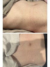 インフィニティ(INFINITY)/シミケア【ボディ】