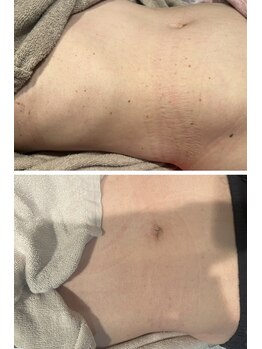 インフィニティ(INFINITY)/シミケア【ボディ】