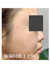 リベル 名古屋(Lebelle:)/ハーブピーリング　名古屋