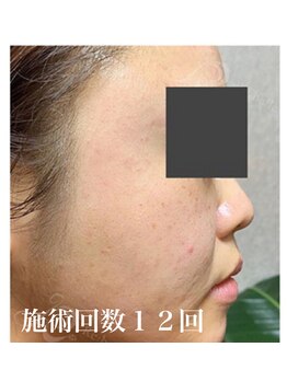 リベル 名古屋(Lebelle:)/ハーブピーリング 名古屋