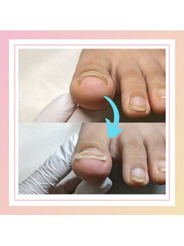 かとり台整骨院 つくば/巻き爪補正