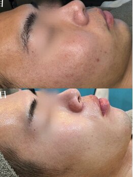 ミリ(MiLi)/ハーブピーリング