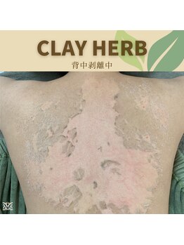 スリジエ ボーテ(cerisierBEAUTE)/お尻ニキビケア黒ずみ結果出し