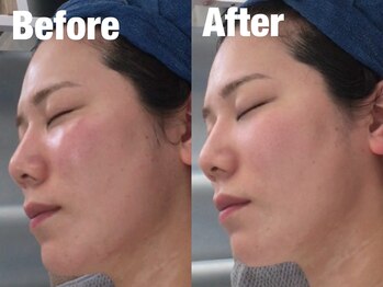 ビーキュート 学芸大学店(BE-CUTE)/毛穴美白トリートメント