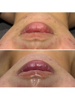 ロッタ エクリュ(Lotta ecru+)/REVI剥けないハーブピーリング