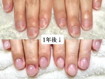 グラシナ なんば店/深爪/自爪育成/フィルイン