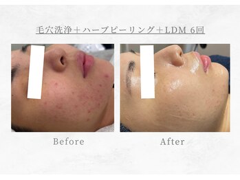 エヴァーグレース 三河安城店(EVER GRACE)/【肌管理】毛穴洗浄+ハーブ+LDM