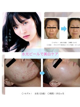 エテル(eter)の写真/【今年こそ本気の肌質改善】皮膚科学研究所から生まれたエクスビアンスの水光ピールで美白ケア！