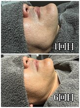 ピーチベル 美濃加茂店(PeachBell)/男性ヒゲ脱毛