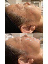 ディサイドロー(DECIDE L.A.W)/before after